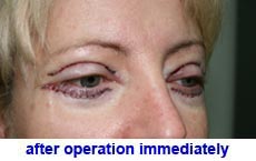 plastic-surgery-blepharoplasty