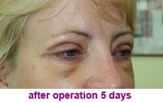 plastic-surgery-blepharoplasty