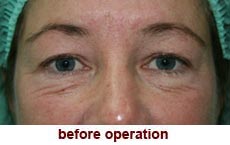 plastic-surgery-blepharoplasty