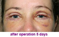 plastic-surgery-blepharoplasty