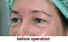 plastic-surgery-blepharoplasty