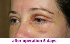 plastic-surgery-blepharoplasty