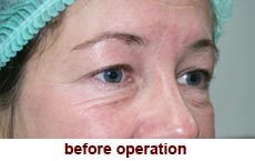 plastic-surgery-blepharoplasty