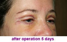 plastic-surgery-blepharoplasty