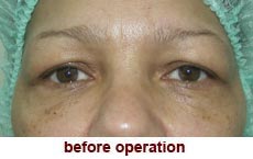 plastic-surgery-blepharoplasty