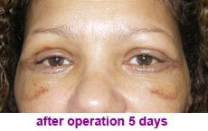 plastic-surgery-blepharoplasty