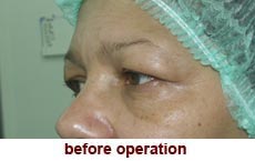 plastic-surgery-blepharoplasty