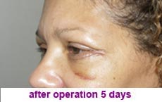 plastic-surgery-blepharoplasty