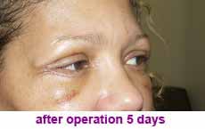 plastic-surgery-blepharoplasty