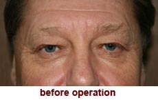 plastic-surgery-blepharoplasty