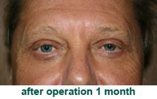 plastic-surgery-blepharoplasty