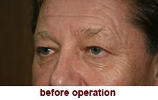 plastic-surgery-blepharoplasty