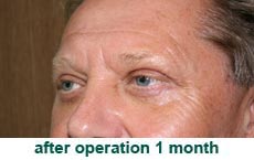 plastic-surgery-blepharoplasty