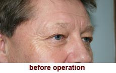 plastic-surgery-blepharoplasty