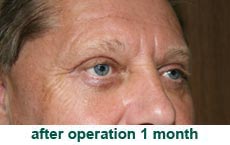 plastic-surgery-blepharoplasty