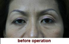 plastic-surgery-blepharoplasty