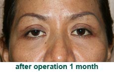 plastic-surgery-blepharoplasty