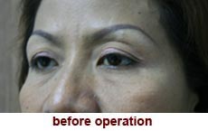 plastic-surgery-blepharoplasty