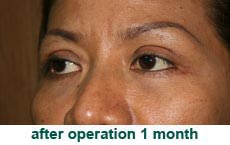 plastic-surgery-blepharoplasty