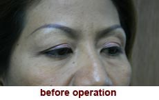 plastic-surgery-blepharoplasty