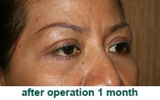 plastic-surgery-blepharoplasty