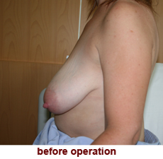 plastic-surgery-breast-lift
