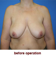 plastic-surgery-breast-lift-augmentation