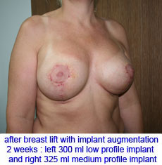 plastic-surgery-breast-lift-augmentation