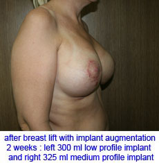 plastic-surgery-breast-lift-augmentation