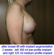 plastic-surgery-breast-lift-augmentation