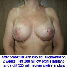 plastic-surgery-breast-lift-augmentation