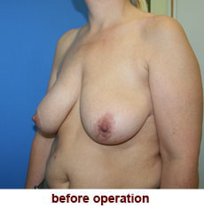 plastic-surgery-breast-lift-augmentation