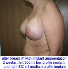 plastic-surgery-breast-lift-augmentation