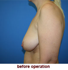 plastic-surgery-breast-lift-augmentation