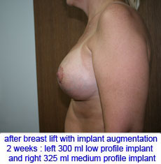 plastic-surgery-breast-lift-augmentation
