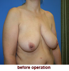 plastic-surgery-breast-lift-augmentation