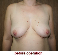 plastic-surgery-breast-lift-augmentation