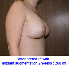 plastic-surgery-breast-lift-augmentation