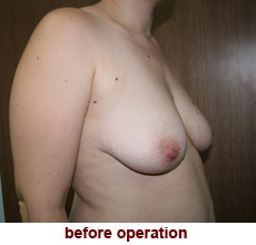 plastic-surgery-breast-lift-augmentation