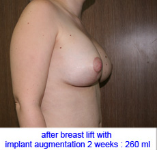 plastic-surgery-breast-lift-augmentation