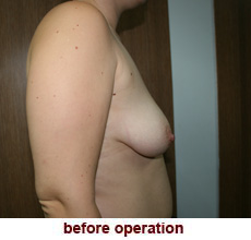 plastic-surgery-breast-lift-augmentation