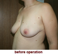 plastic-surgery-breast-lift-augmentation