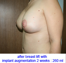 plastic-surgery-breast-lift-augmentation