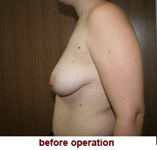 plastic-surgery-breast-lift-augmentation