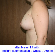 plastic-surgery-breast-lift-augmentation