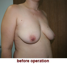 plastic-surgery-breast-lift-augmentation