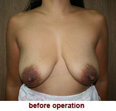 plastic-surgery-breast-lift-augmentation
