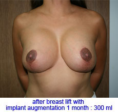 plastic-surgery-breast-lift-augmentation