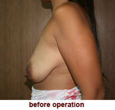 plastic-surgery-breast-lift-augmentation