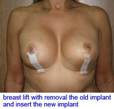 plastic-surgery-breast-lift-augmentation